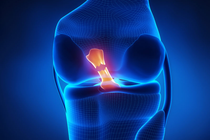 graft ACL repair graphic