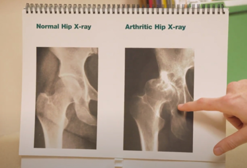 medical graphic showing normal vs arthritis hip